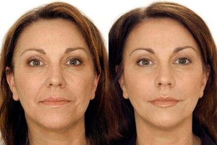 Face GLP massage before and after