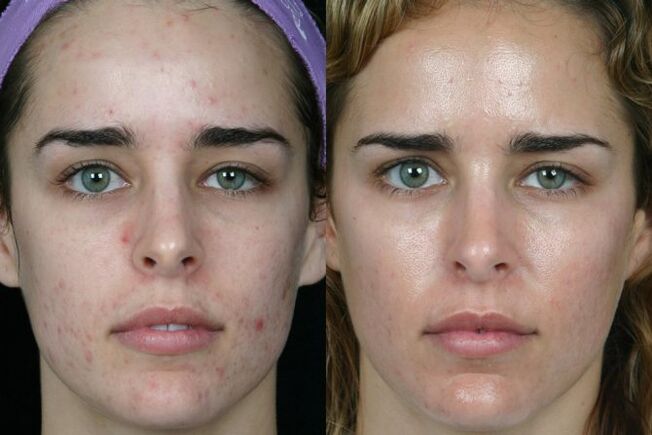 Laser grinding of the skin of the face before and after