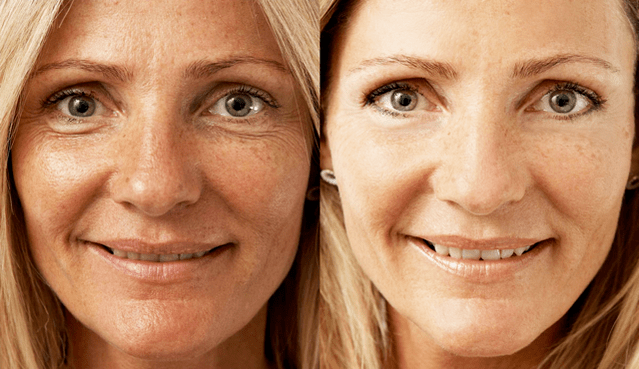 Unit links before and after